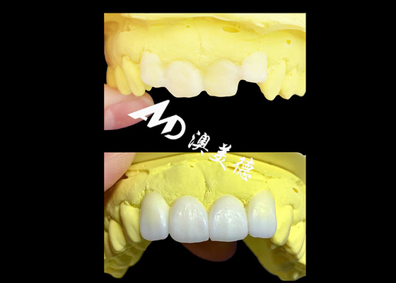 Dobra cena. Niestandardowe przezroczystych Zirconia korony stomatologiczne wykonane przez AMD Dental Lab w Internecie