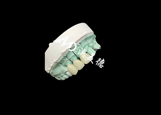 Dobra cena. Emax Ceramic Crown - dostosowalne i niedrogie rozwiązanie do odbudowy zębów w Internecie