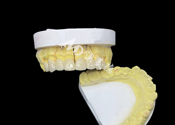 Dobra cena. Zdobądź doskonały uśmiech dzięki wysokiej jakości ceramicznym koronom zębowym, które zapewniają naturalny wygląd i trwałą wytrzymałość w Internecie