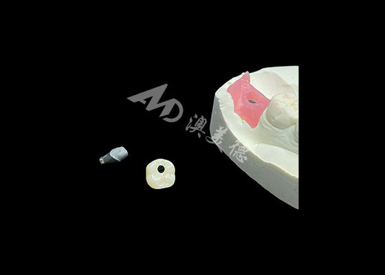 Dobra cena. Korony na implantach rewolucjonizują procedury stomatologii odtwórczej w Internecie