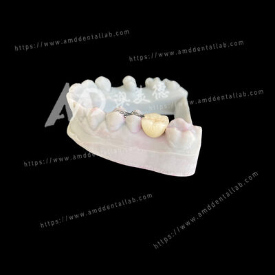 Dobra cena. PFM Most Maryland Bridge z jednym przęsłem i dwoma skrzydłami - rozwiązanie konserwatywne i estetyczne w Internecie