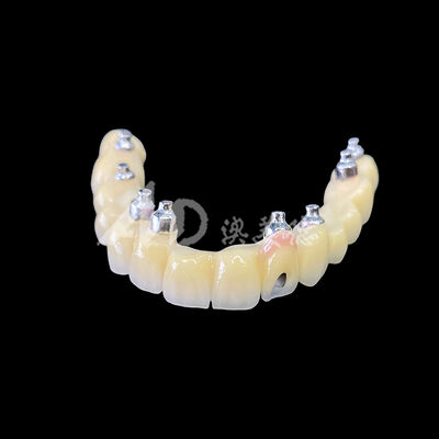 Dobra cena. Porcelan-Fused-to-Metal (PFM) Implant-Bridge z wkrętem w Internecie